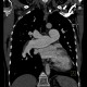 Chronic lung embolism, pulmonary hypertension: CT - Computed tomography